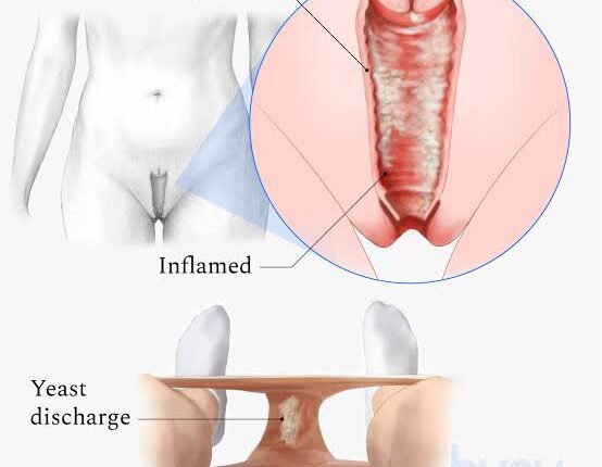 Understanding Yeast Infections: Causes, Symptoms, and Treatment