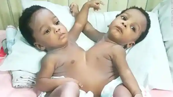 Conjoined Twins Separated in Nigeria