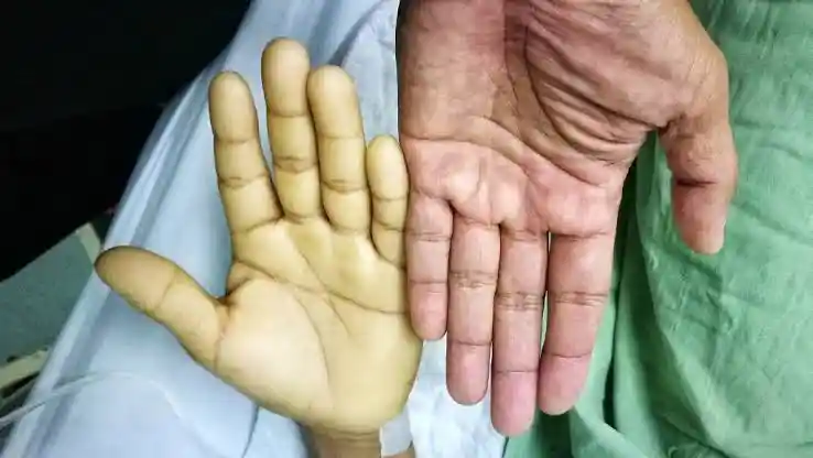 Anaemia in Nigeria: Causes, Symptoms, Types, Treatment, and Foods to Eat