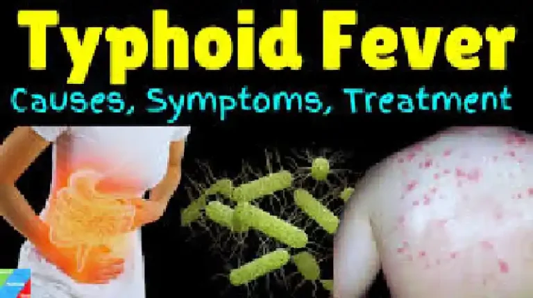 Typhoid Fever in Nigeria: Symptoms, Causes, and Prevention